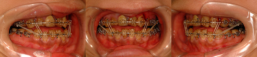 口唇口蓋裂の治療例　左側唇顎口蓋裂に起因する顔面非対称を呈する骨格性下顎前突　顎矯正手術１８日後　口腔内